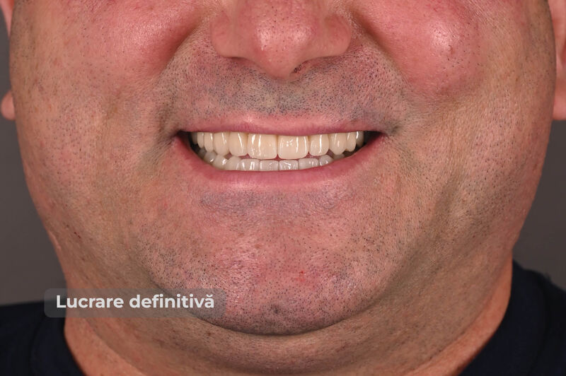 Zâmbet lateral stanga_dupa